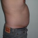 TUMMY BEFORE MPX SMART LIPO